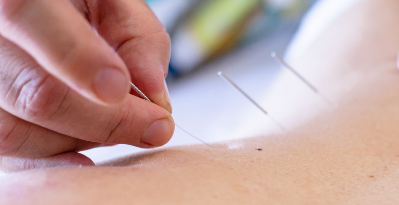 Fertility Acupuncture