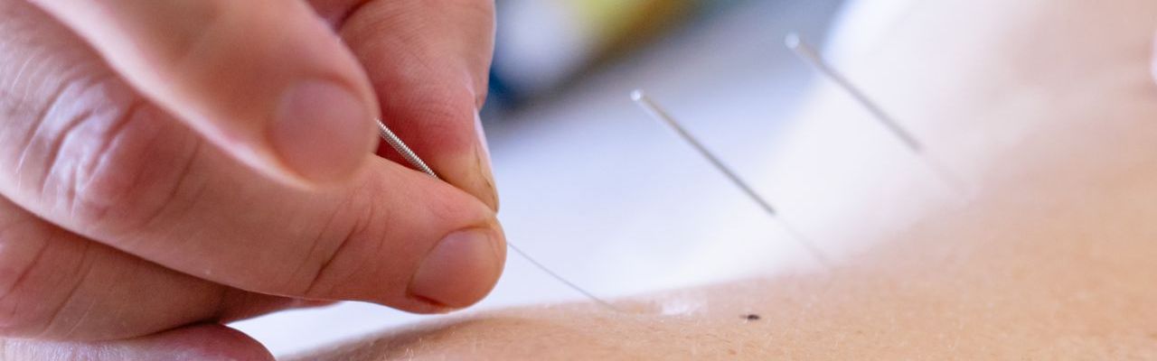 Fertility Acupuncture